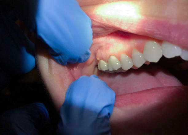Best Emergency Wisdom Teeth Removal in Jacinto City, TX